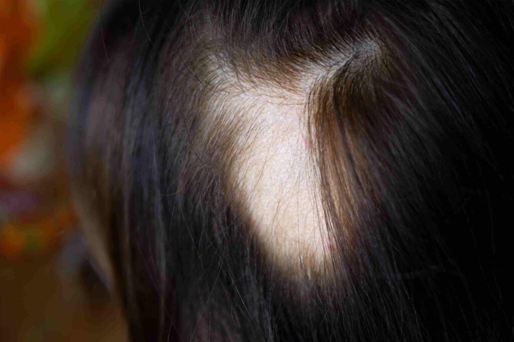 woman-hair-alopecia