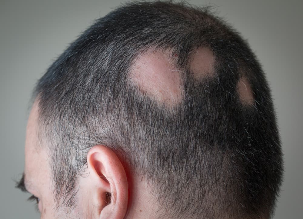 alopecia hair tattoo before and after