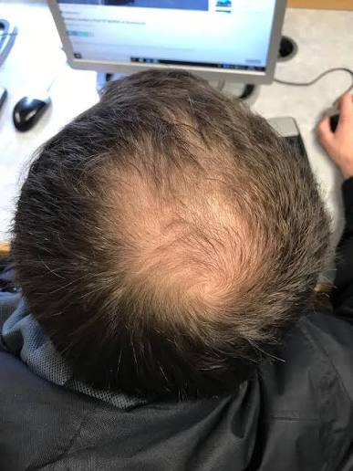 thinning hair tattoo before and after